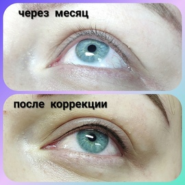 Межресничка