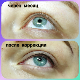 Коррекция межреснички